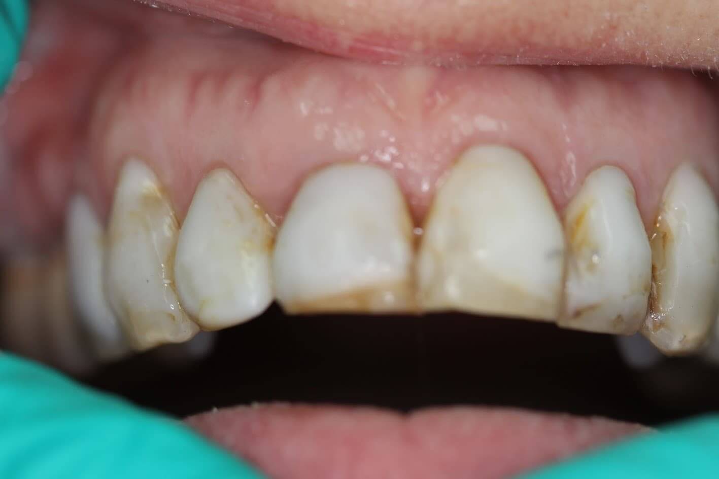hammond dental before